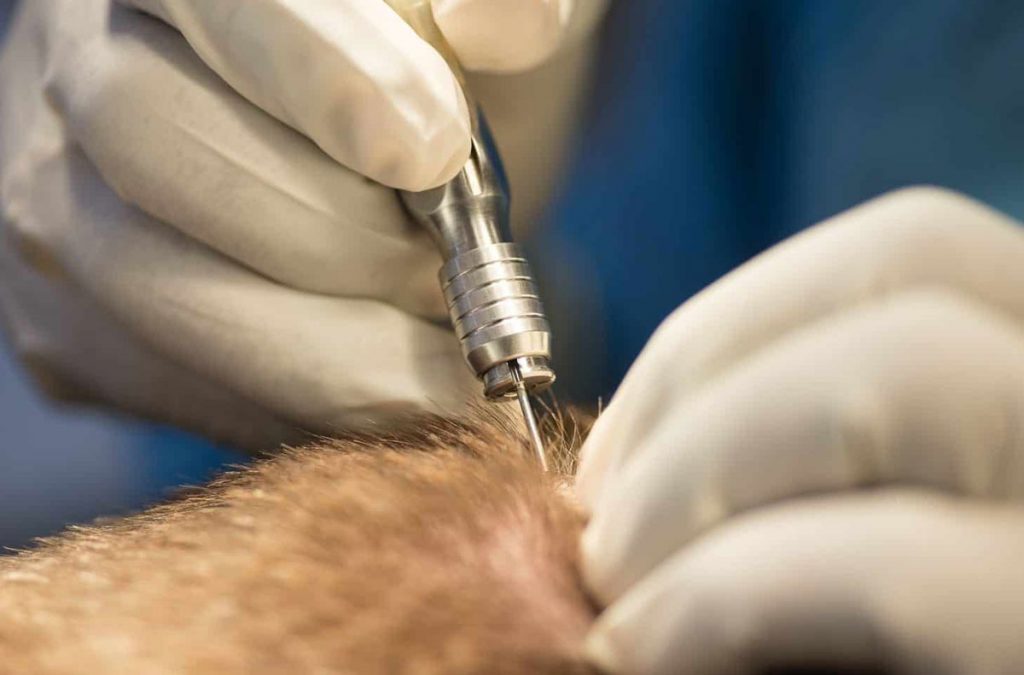 What is the Recovery Time After Hair Transplantation?